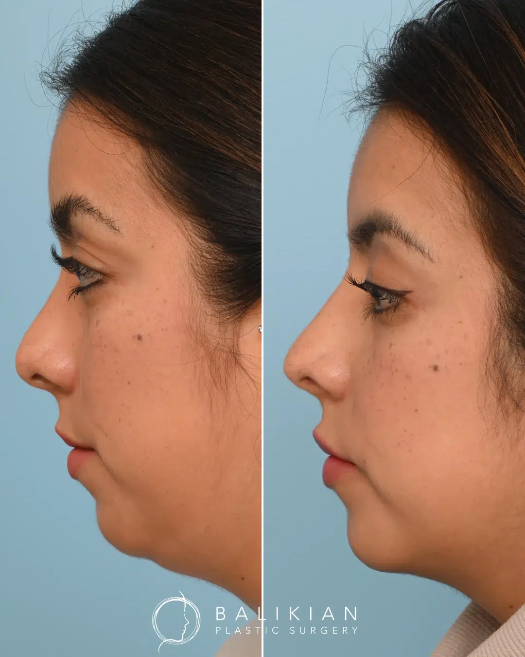 Before and after revision rhinoplasty, opposite side view. Straighter bridge, improved contour, better symmetry.