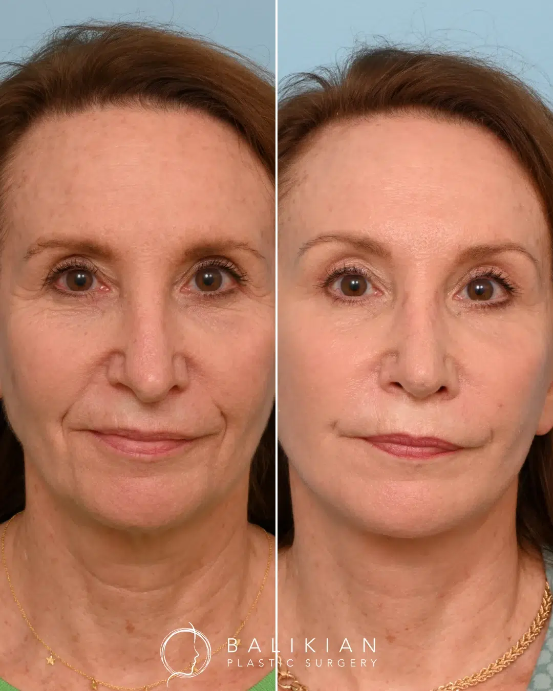 Before and after revision rhinoplasty, front view. Straighter bridge, refined tip, improved symmetry.