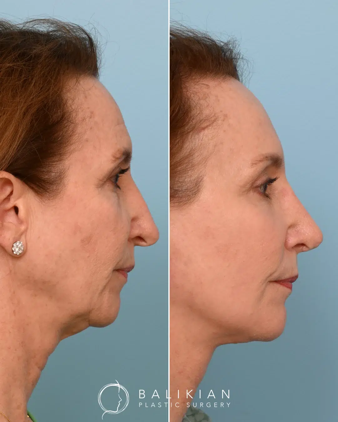 Before and after revision rhinoplasty, opposite angled view. Hump removed, tip elevated, harmonized profile.