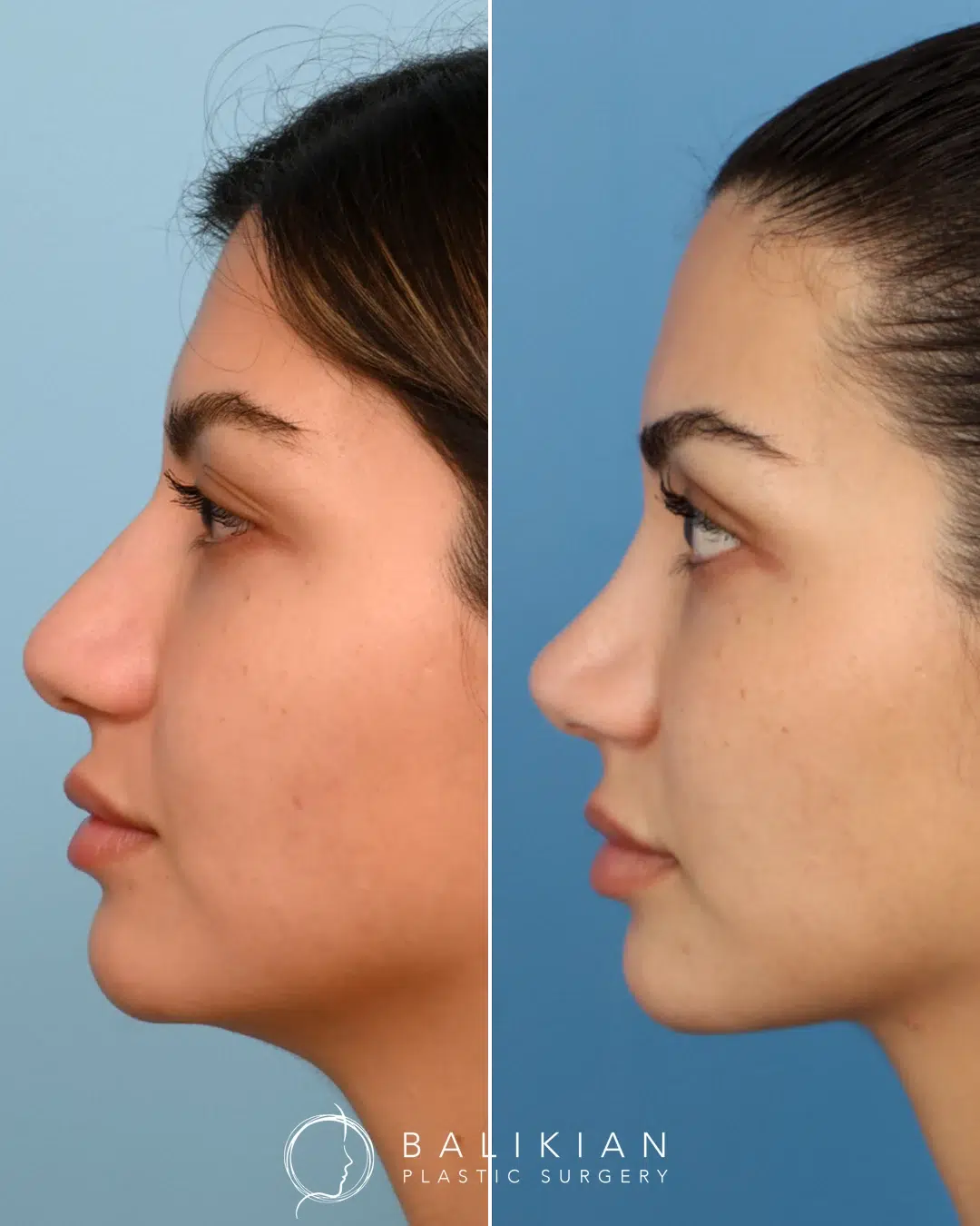 Side profile of female patient before rhinoplasty with dorsal hump and nasal tip projection.