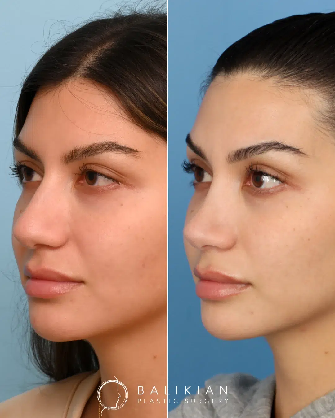 Side profile after rhinoplasty with smoother bridge and more refined nasal tip.