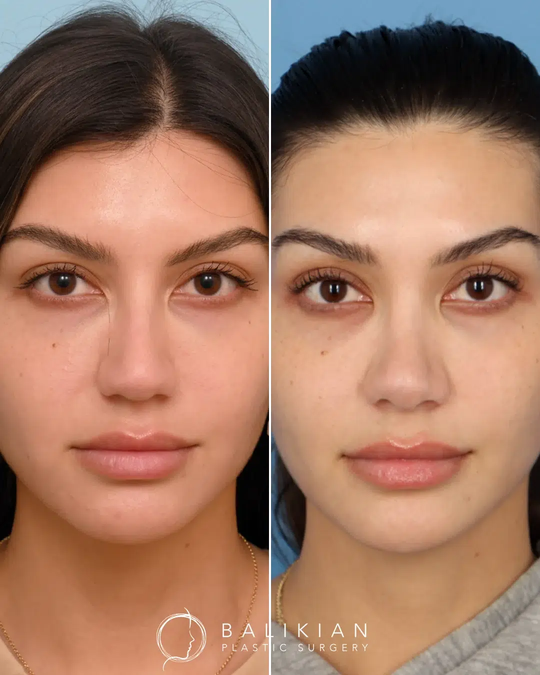Front view before rhinoplasty showing wider nasal bridge and tip.
