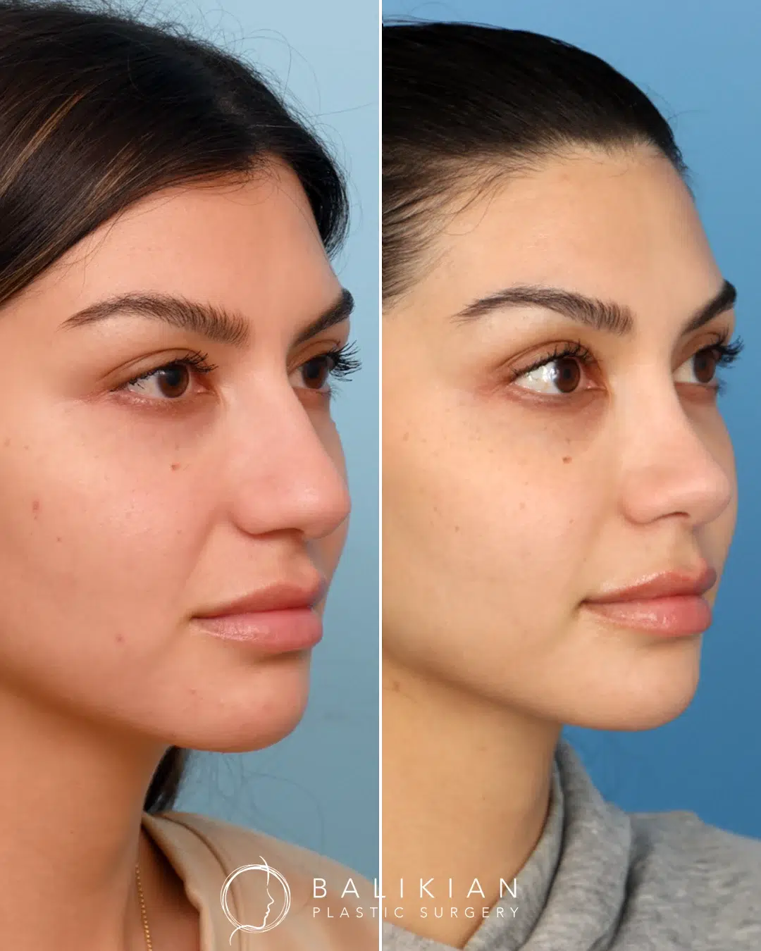 Front view after rhinoplasty showing narrower bridge, balanced proportions, and refined nasal tip.