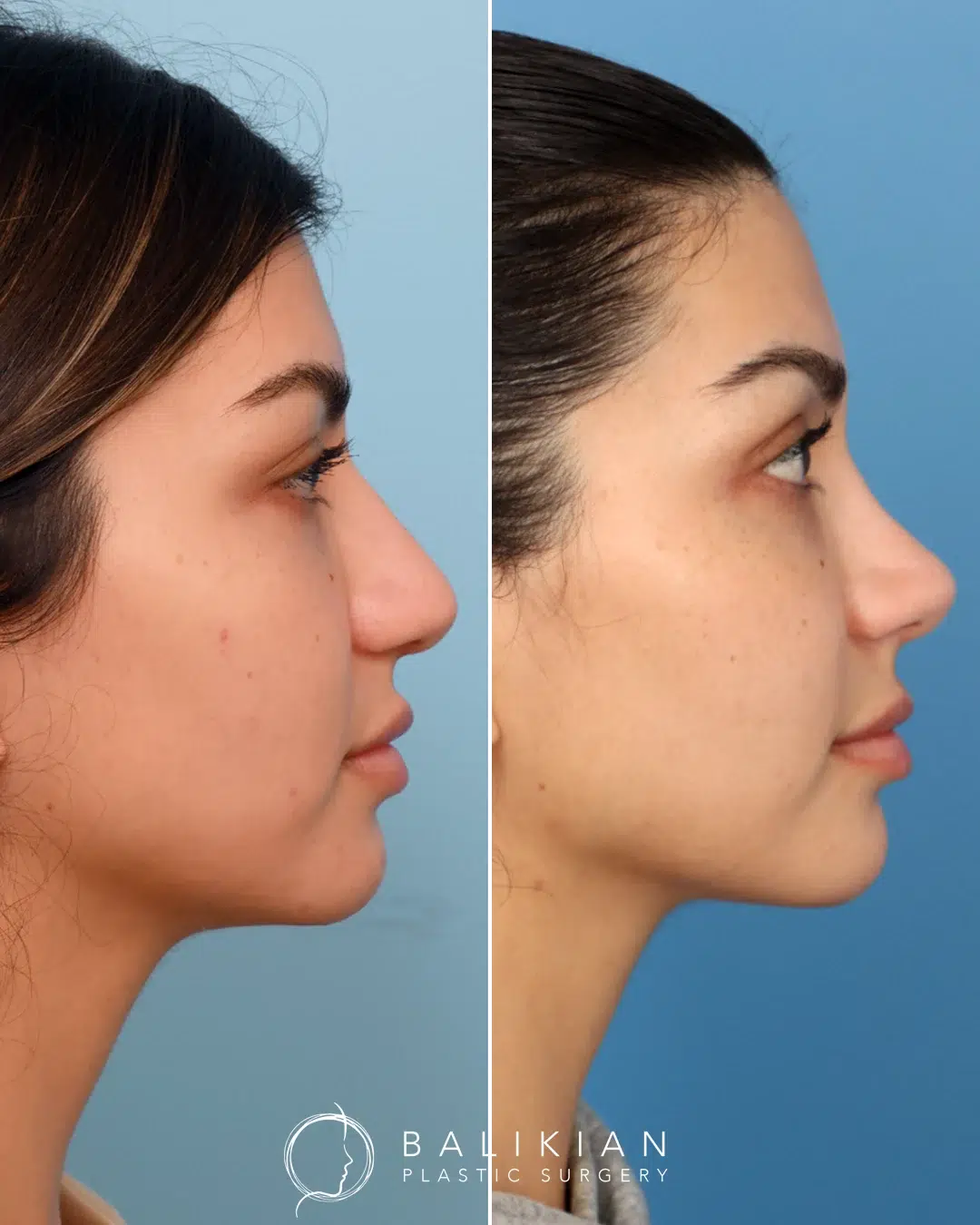 Before photo of a rhinoplasty patient with dorsal hump and downward sloping tip.