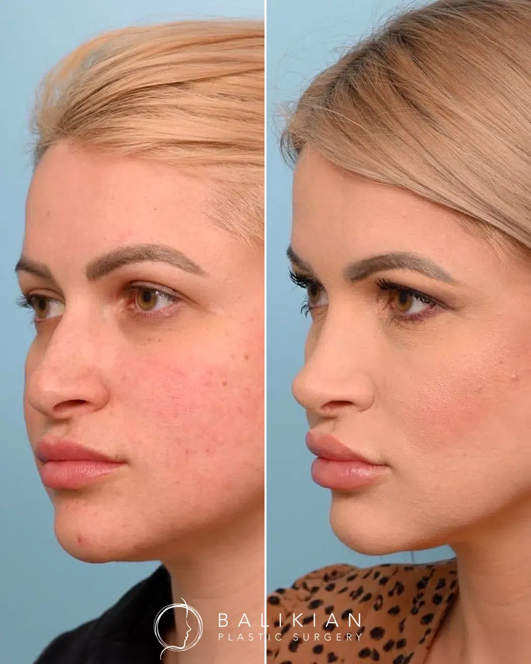Before and after rhinoplasty, profile view, hump reduced and tip gently lifted for a smoother contour.