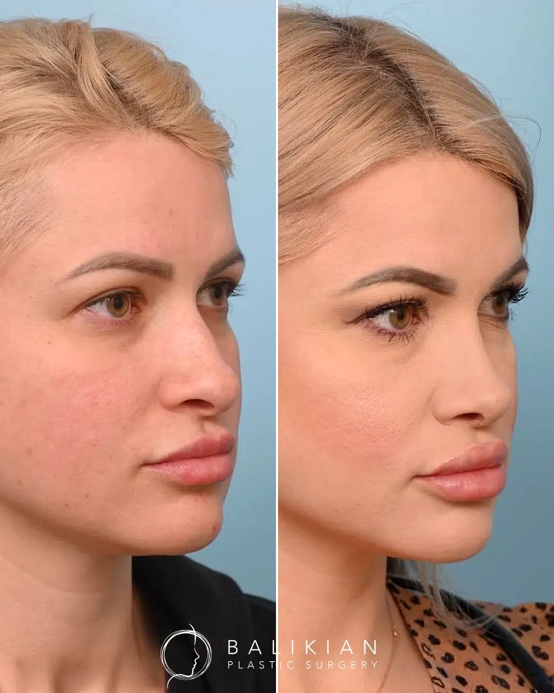 Before and after rhinoplasty, oblique view, bridge refined and tip softened while preserving her look.