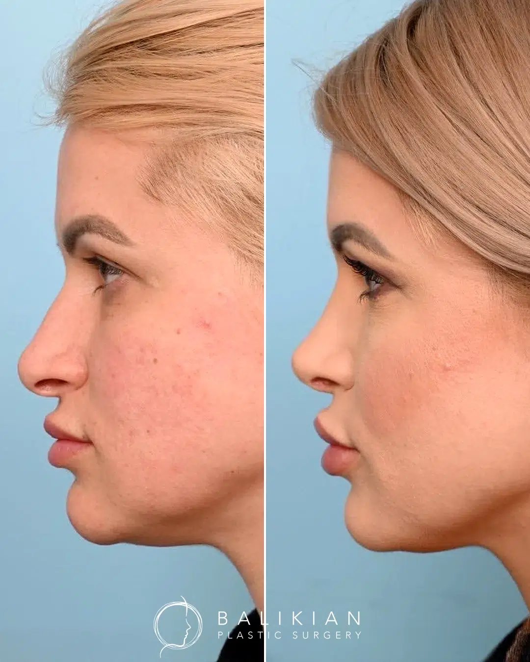 Before and after rhinoplasty, oblique view, straighter dorsum with subtle tip refinement.