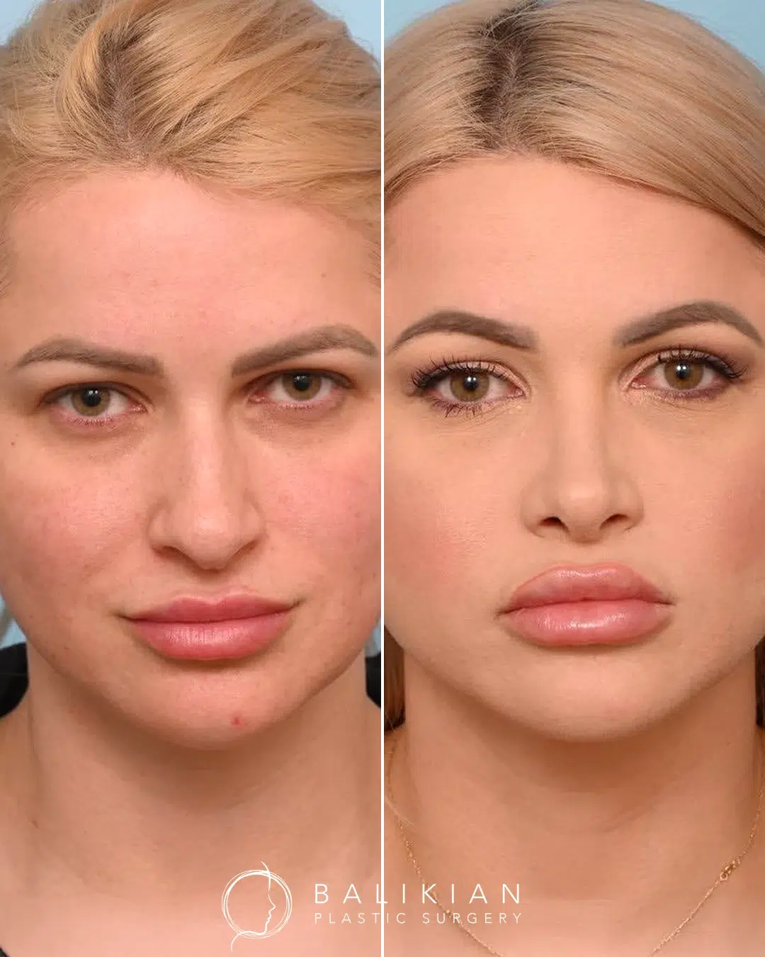 Before and after rhinoplasty, front view, improved nasal alignment and gentle tip narrowing.