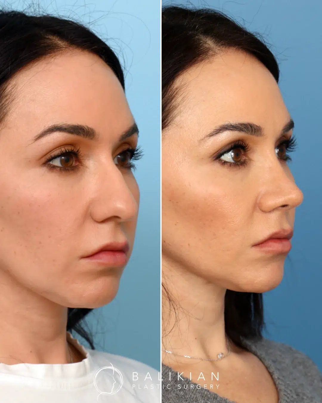Side profile view of a female rhinoplasty patient before and after surgery, showing a smoother nasal bridge and refined nasal tip for improved facial balance.