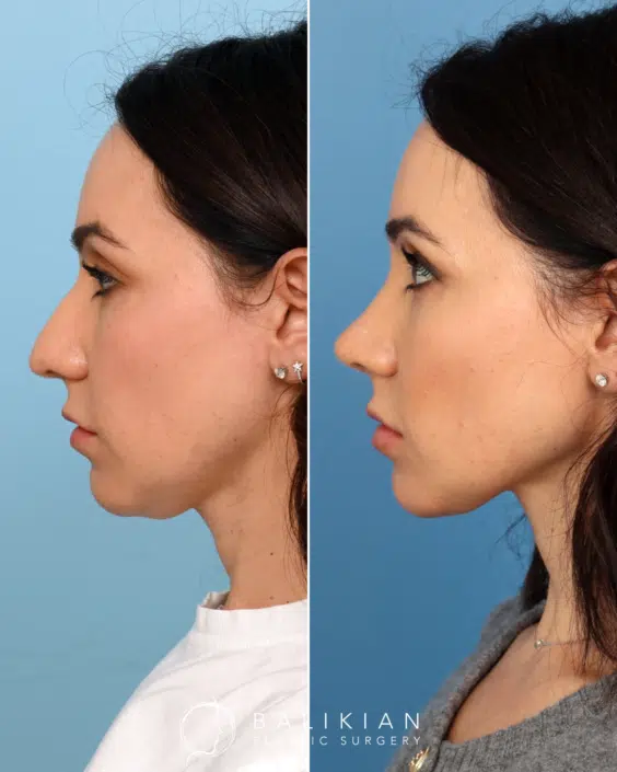 Side profile view of a female rhinoplasty patient before and after surgery, highlighting a straightened nasal bridge and a more refined tip.