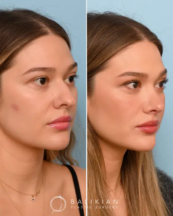 Three-quarter view of a female rhinoplasty patient before and after surgery, displaying a smoother nasal contour and balanced proportions.