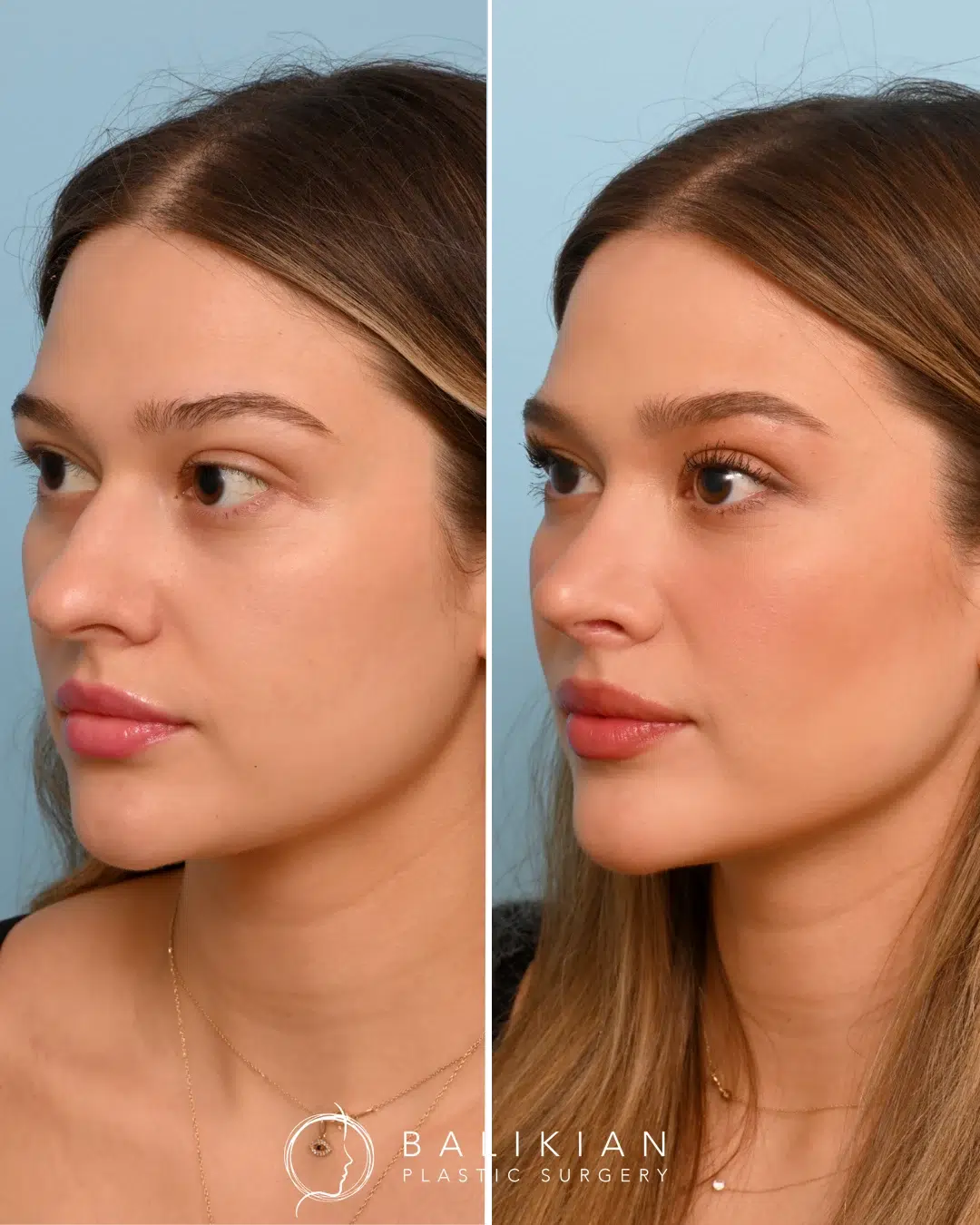 Oblique view of a female rhinoplasty patient before and after surgery, showing refined nasal definition and improved profile aesthetics.