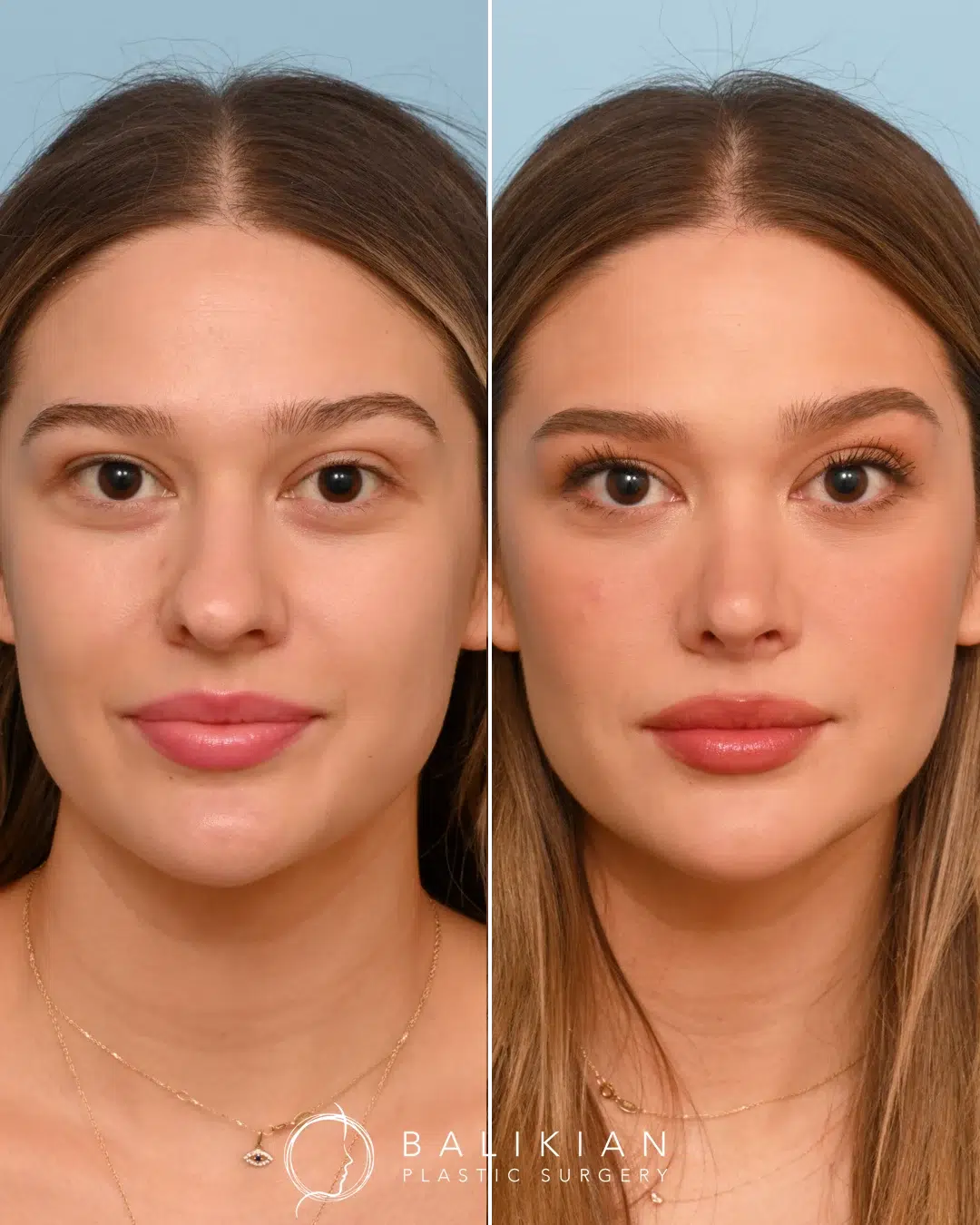 Front view of a female rhinoplasty patient before and after surgery, illustrating improved nasal symmetry and a natural-looking result.