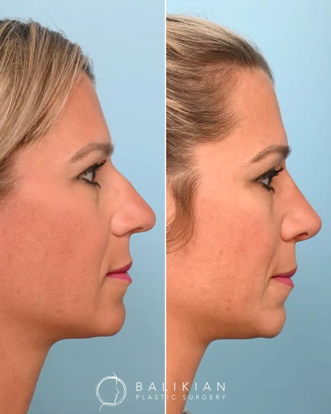 Before and after rhinoplasty, profile view, dorsal hump reduction for a straight balanced nasal profile.