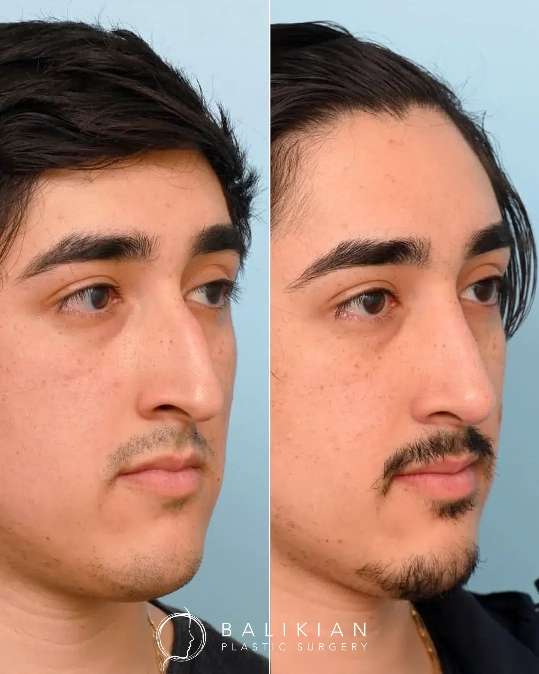 Male rhinoplasty before and after. Oblique view. Dorsal hump reduced with a smoother bridge while keeping a masculine profile.