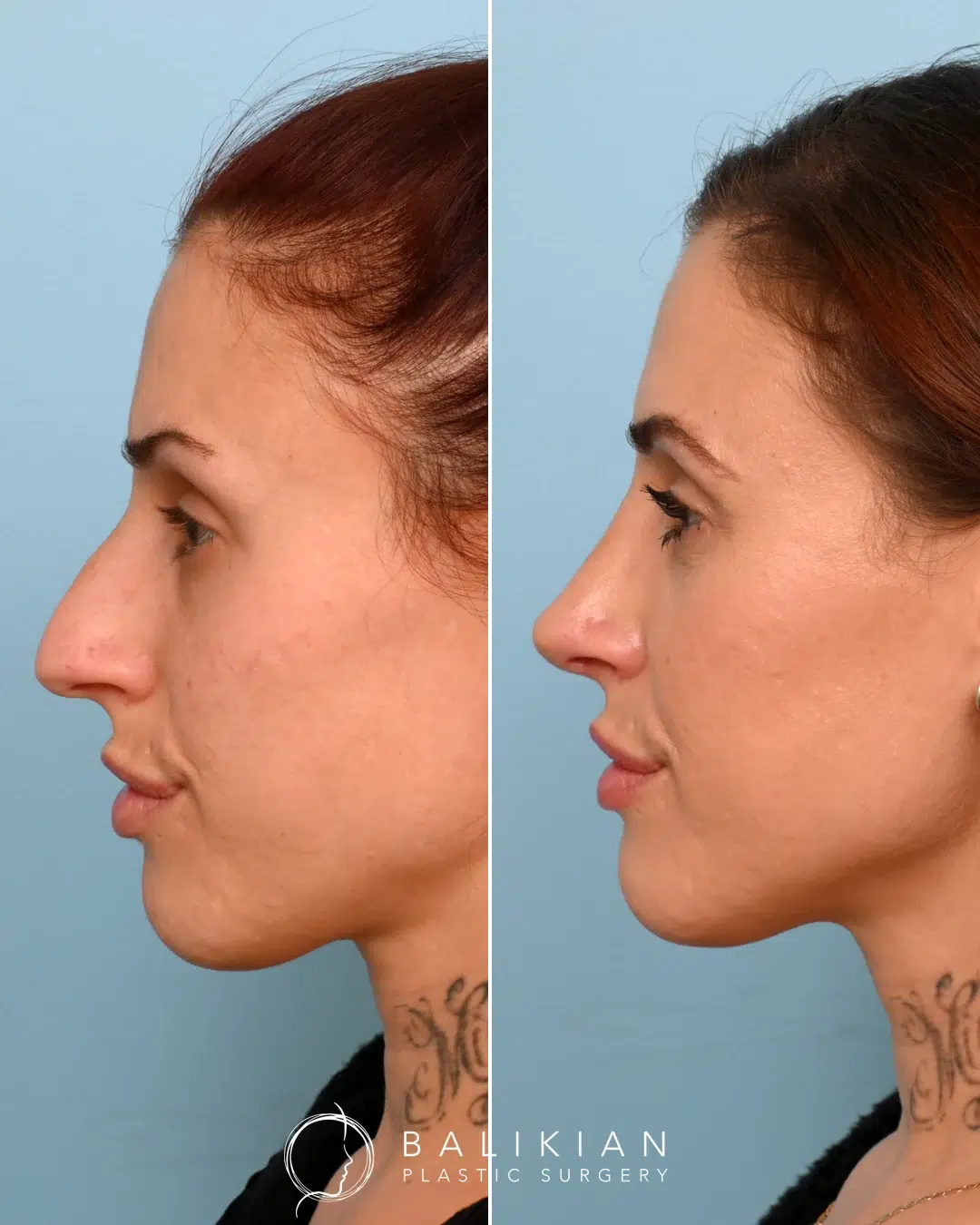 Side profile view of a female rhinoplasty patient before and after surgery, demonstrating a reduced dorsal hump and a more elegant nasal profile.