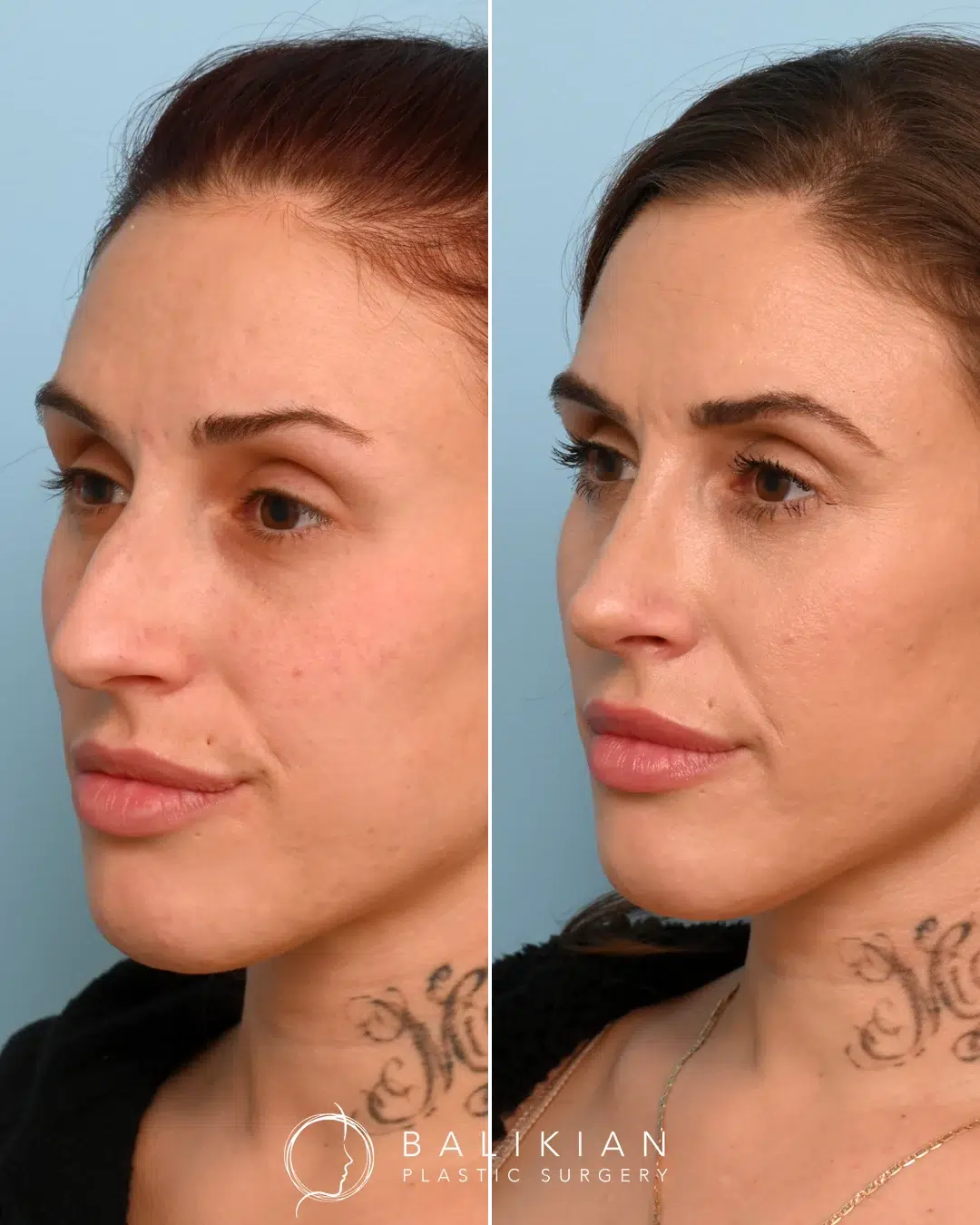 Three-quarter view of a female rhinoplasty patient before and after surgery, emphasizing a refined nasal shape and harmonious facial balance.