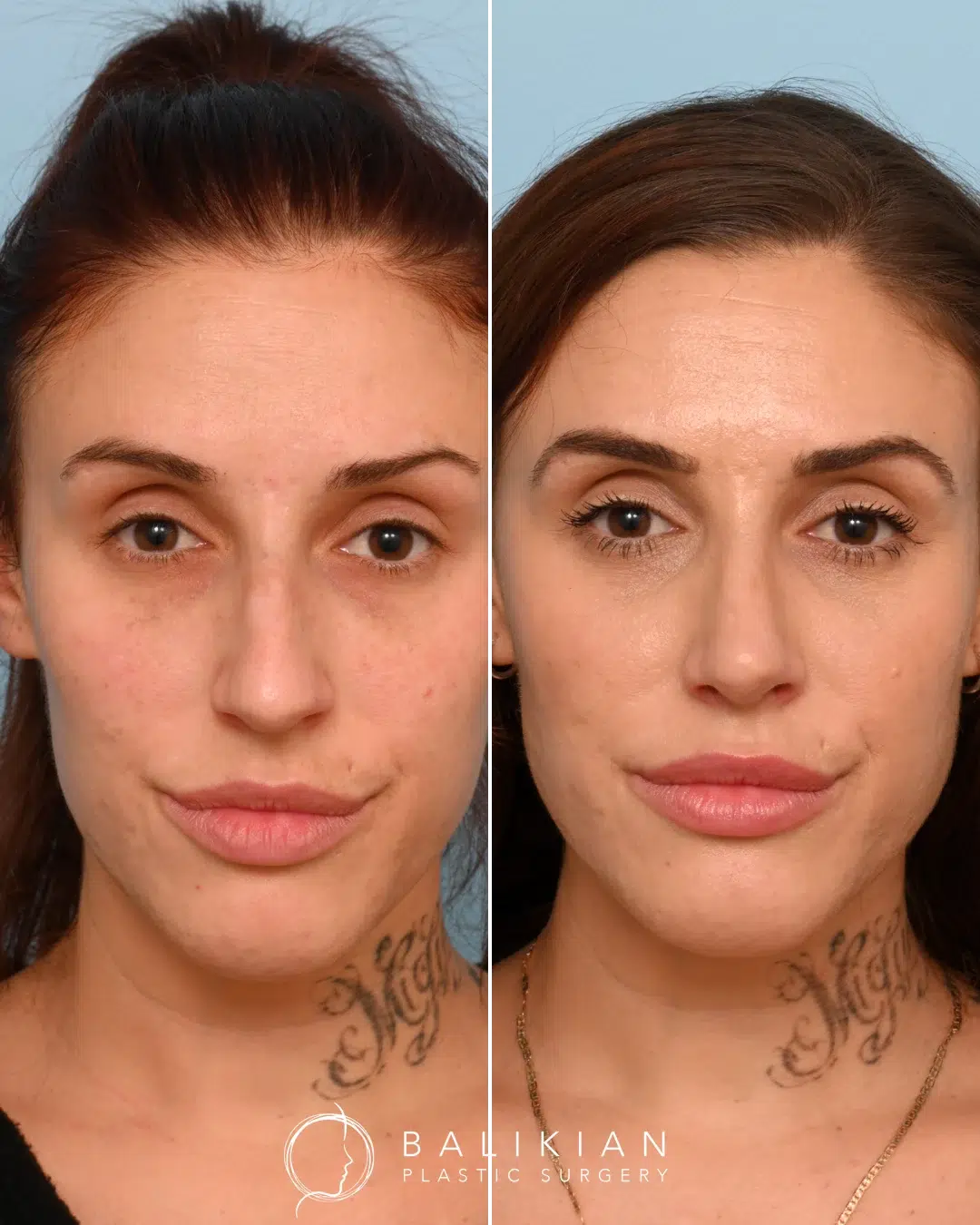 Three-quarter view of a female rhinoplasty patient before and after surgery, emphasizing a refined nasal shape and harmonious facial balance.