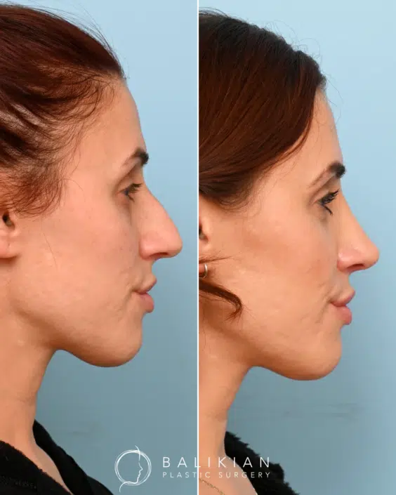 Side profile view of a female rhinoplasty patient before and after surgery, showing removal of a prominent dorsal hump for a smoother nasal bridge.