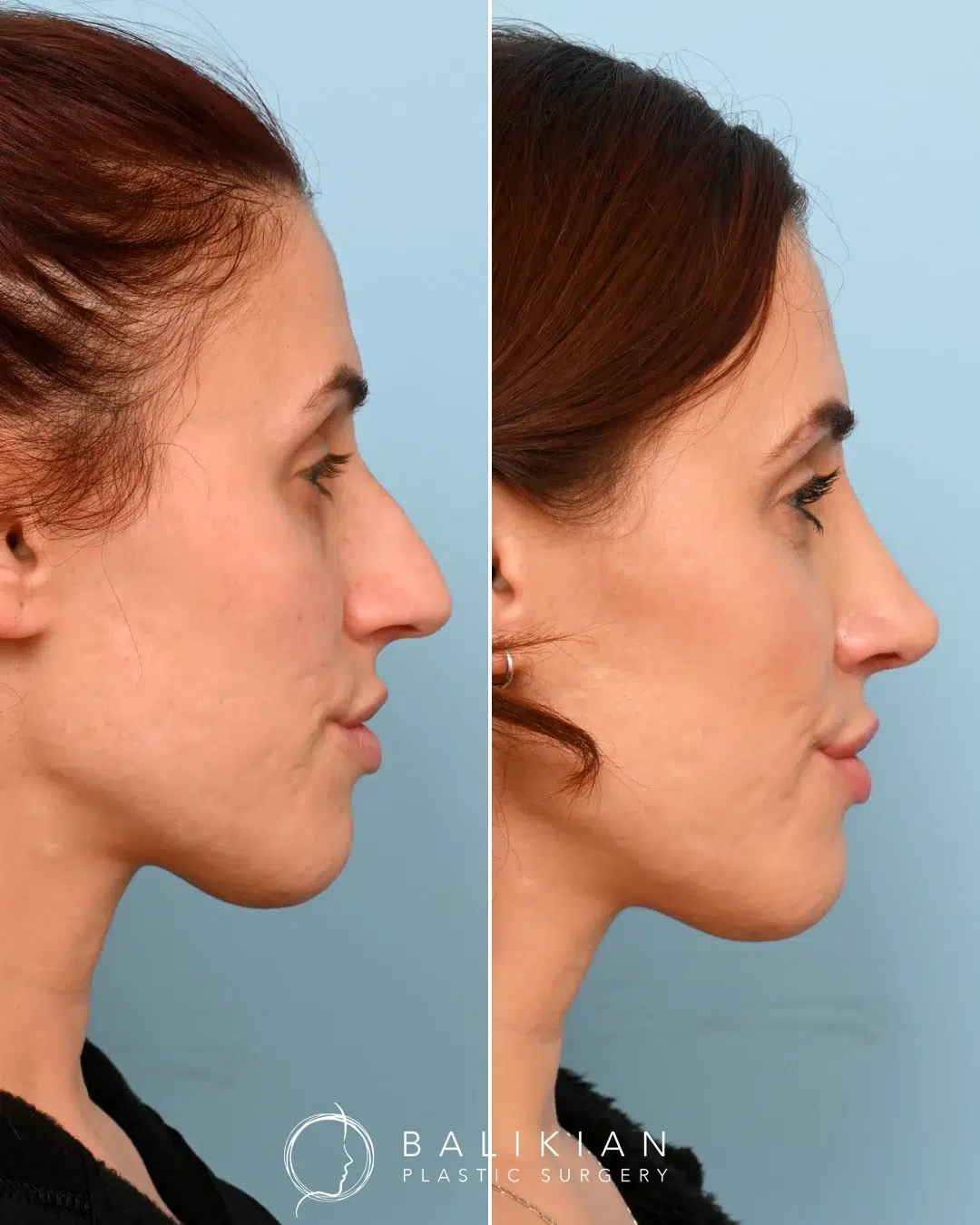 Side profile view of a female rhinoplasty patient before and after surgery, showing removal of a prominent dorsal hump for a smoother nasal bridge.