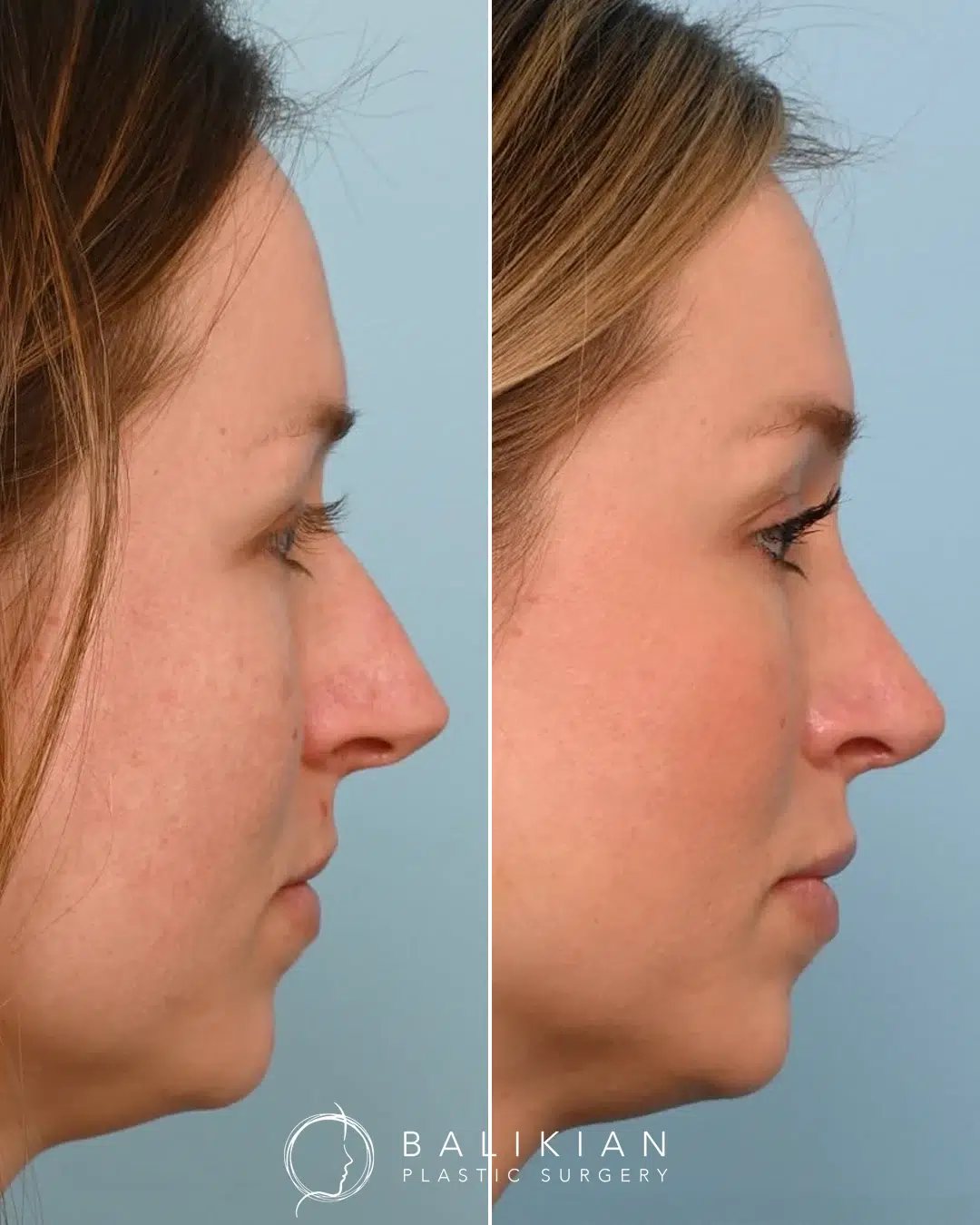 Rhinoplasty before and after. Left profile. Dorsal hump reduced and nasal tip refined for a straighter, softer bridge.