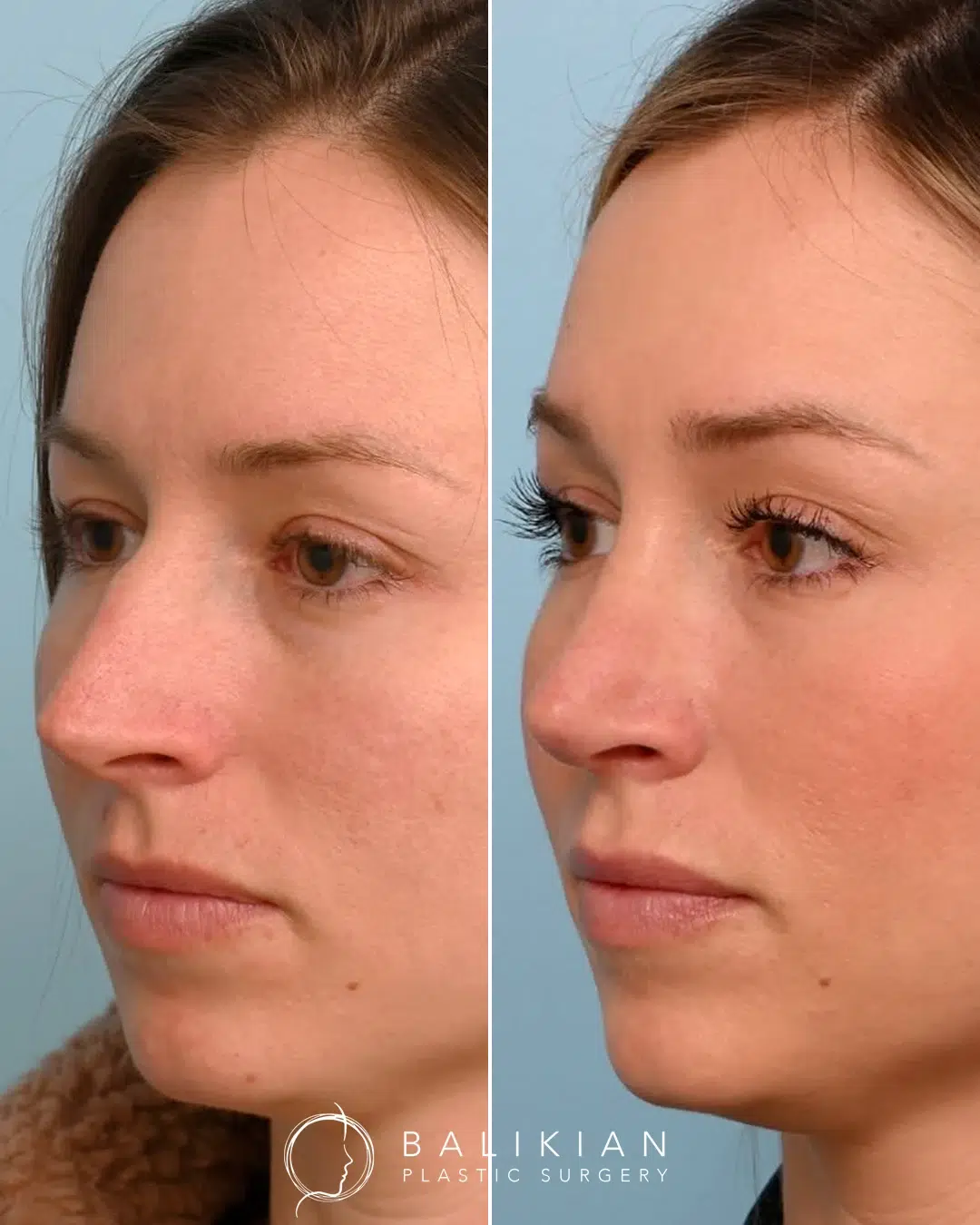 Rhinoplasty before and after. Left oblique view. Bridge smoothed and tip softened with balanced side profile.
