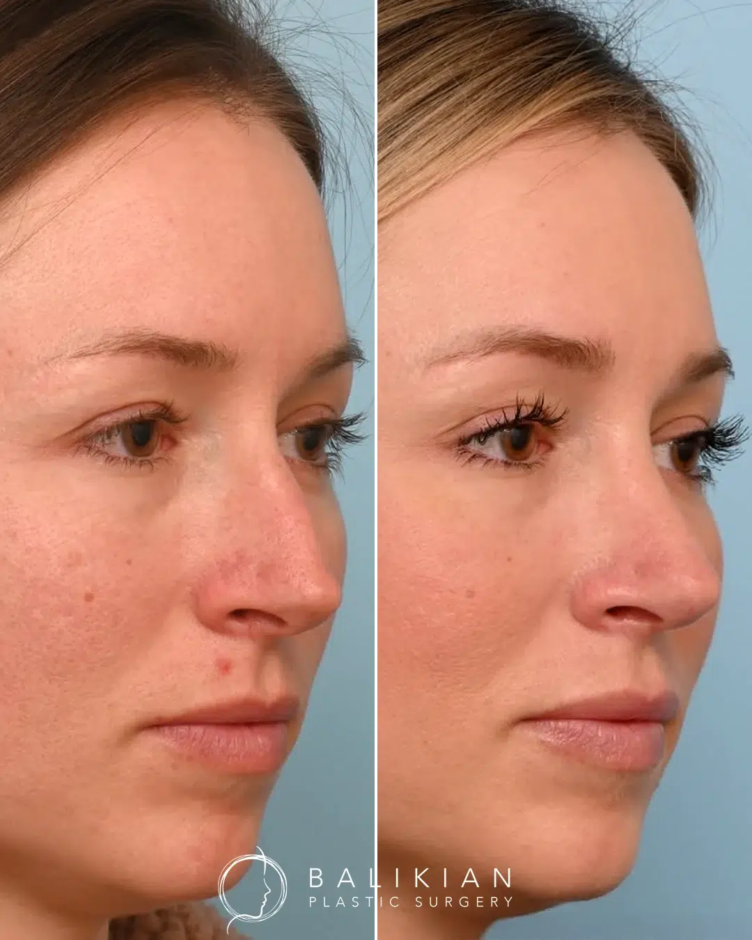 Rhinoplasty before and after. Right oblique view. Straighter bridge and refined tip for a more balanced nose.