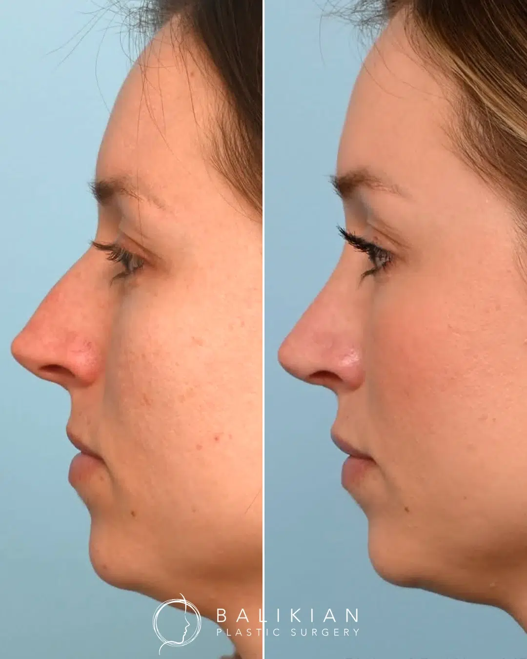 Rhinoplasty before and after. Right profile. Dorsal hump reduction with a smoother bridge and natural tip definition.