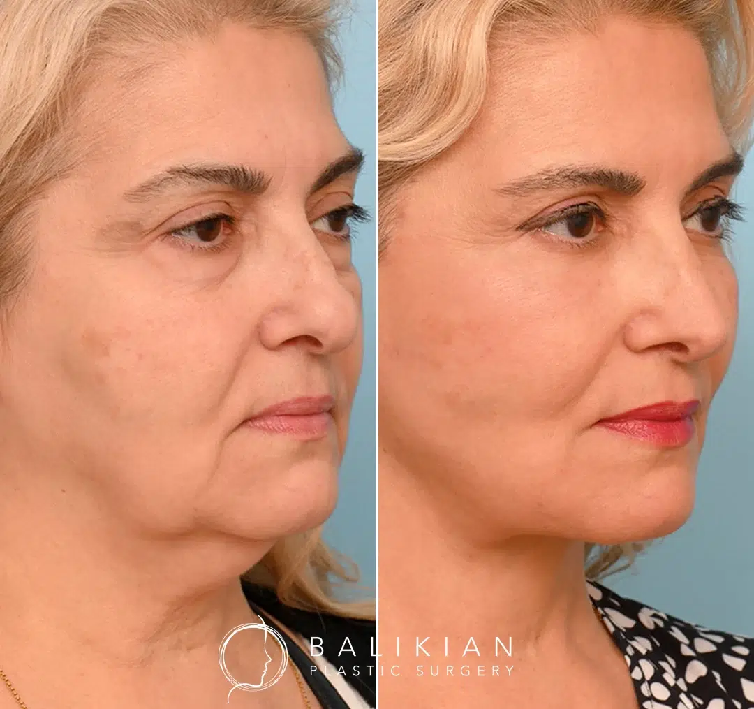 Side view before and after facelift, showing defined neckline and reduced sagging.