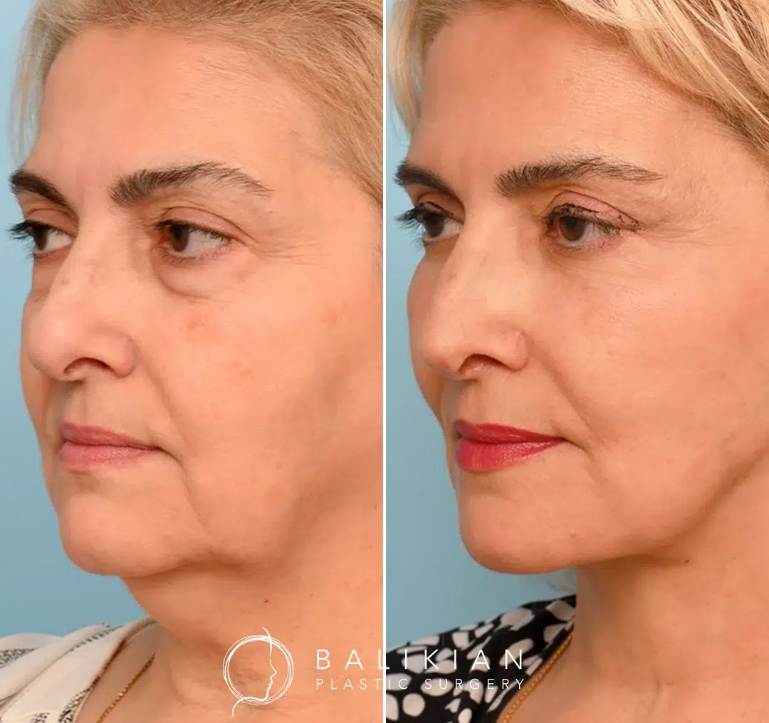 Angled view before and after facelift, showing improved contour and lifted cheeks.