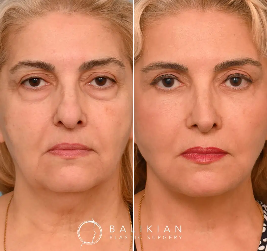 Frontal view before and after facelift, showing tighter jawline and smoother midface.