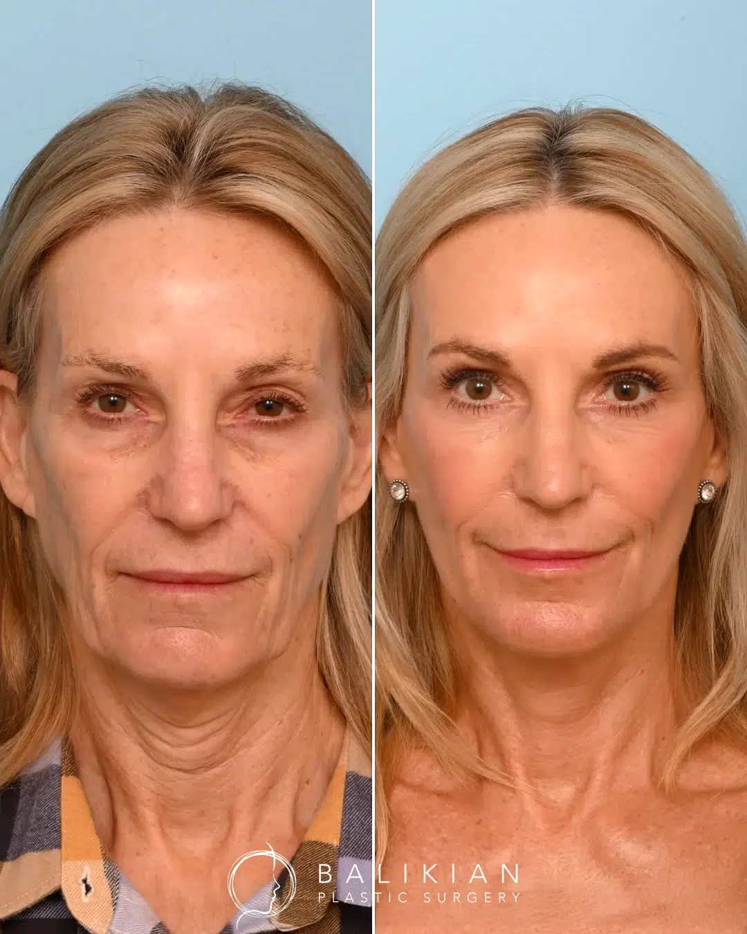 Front view before and after deep plane facelift in Southern California showing refined lower face and natural results.