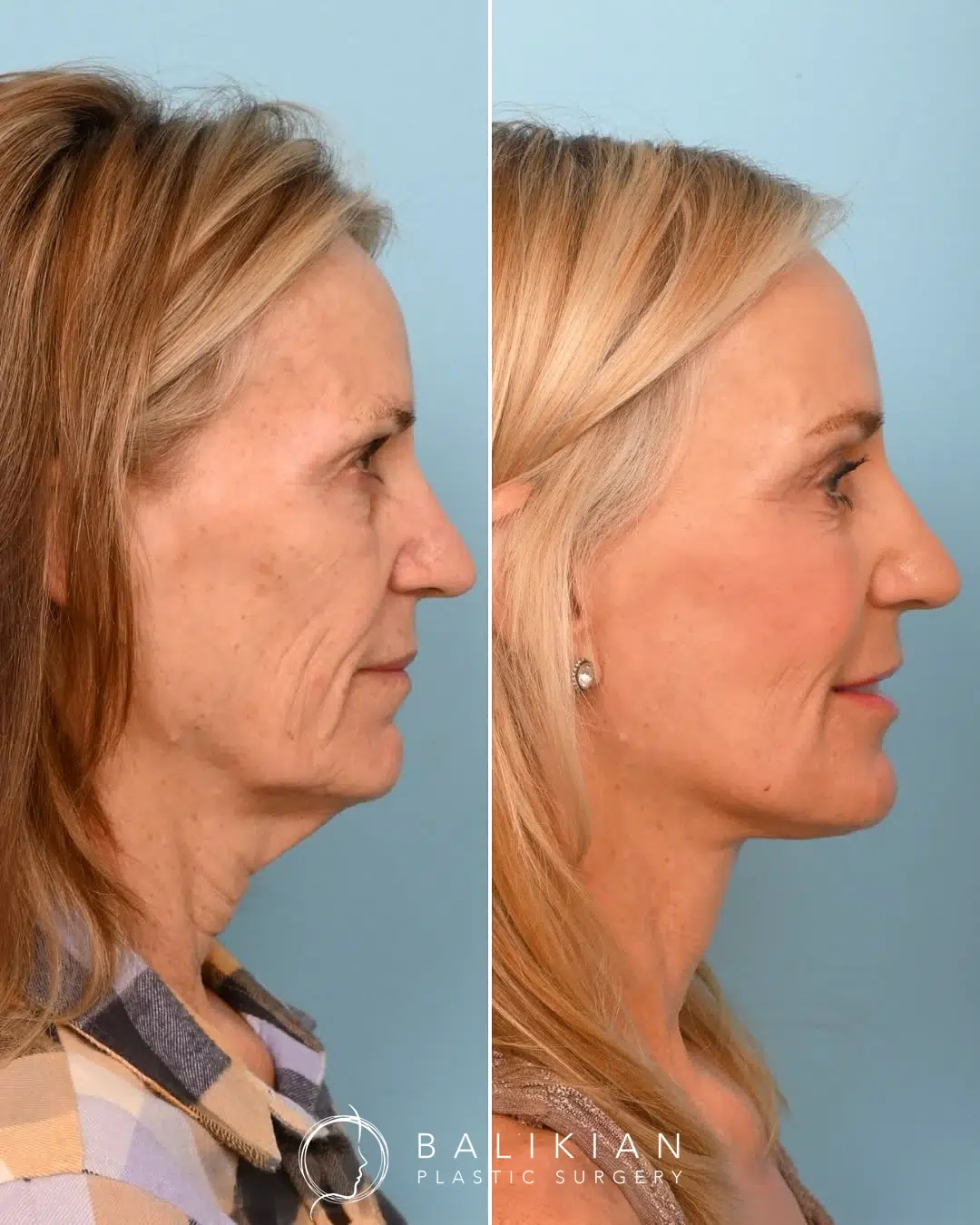 Profile view before and after facelift highlighting tighter chin angle and sculpted neck.