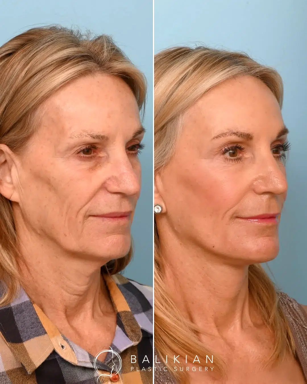 Three-quarter view before and after facelift showing improved jawline and smoother neckline.