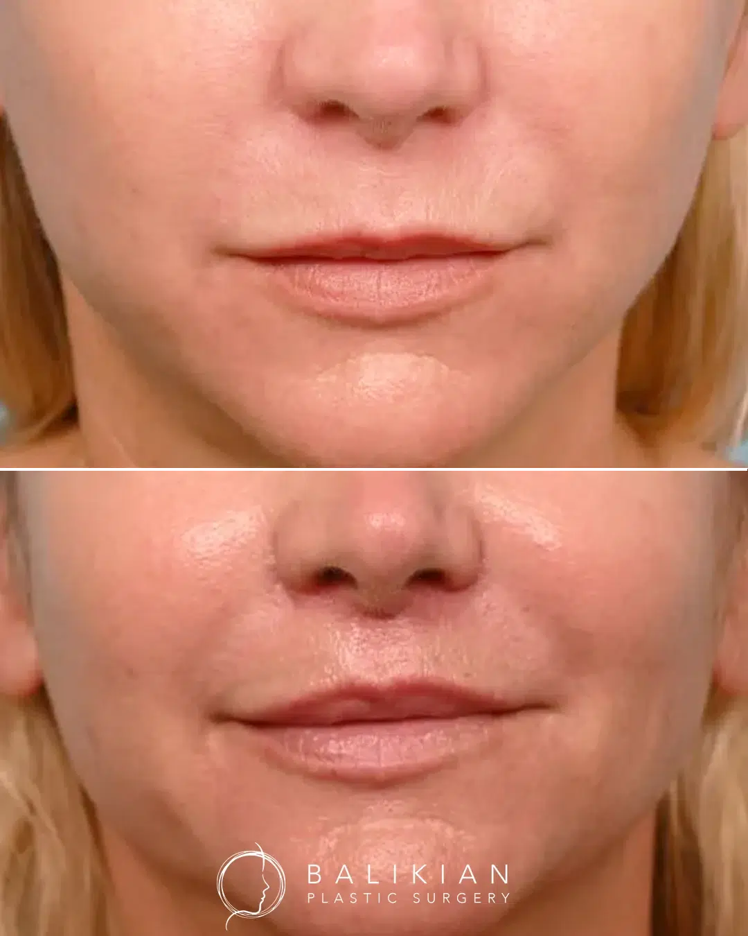 Surgical lip lift before and after front view revealing youthful lip shape and improved vertical balance between nose and lip.