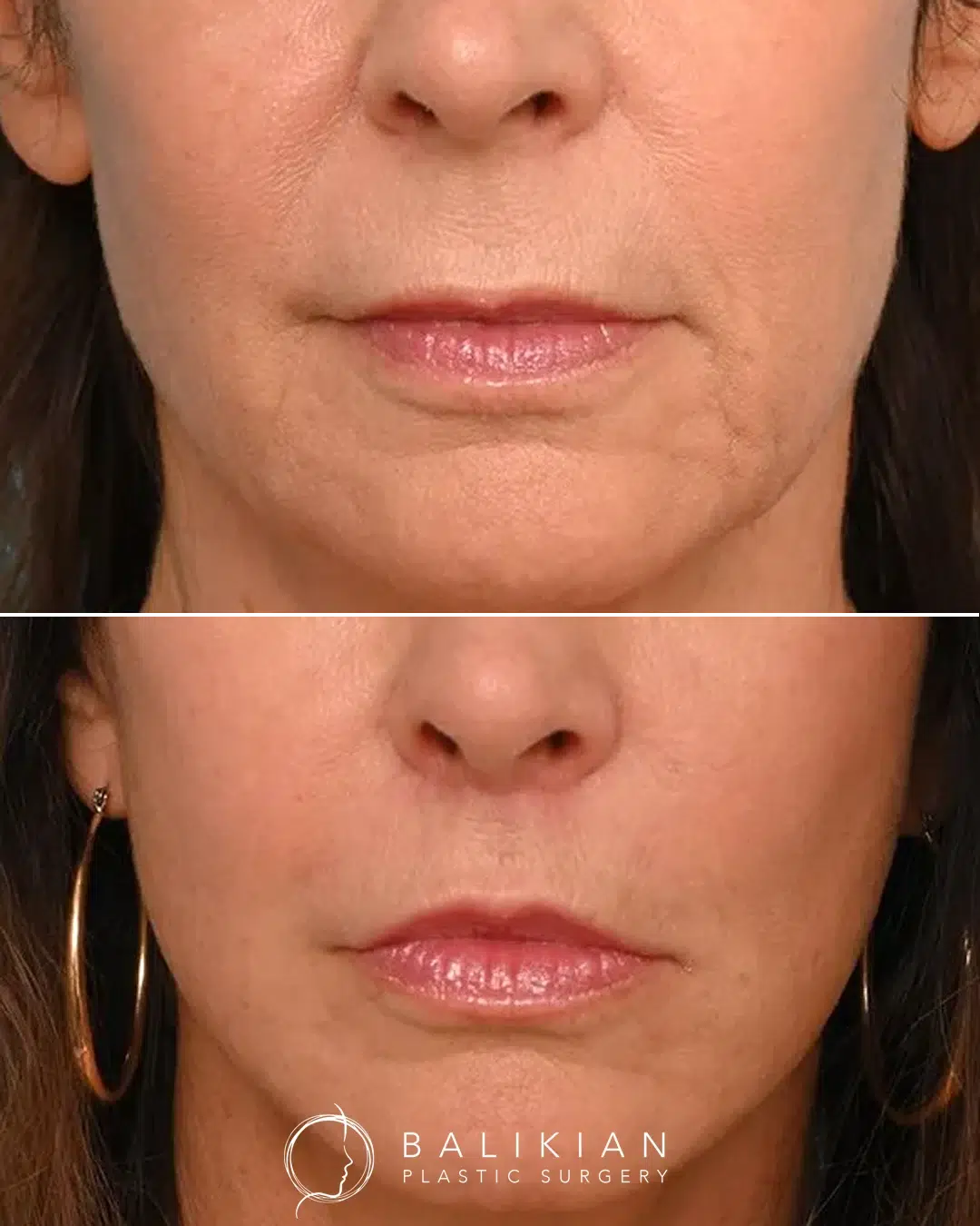 Upper lip lift before and after close-up with refined cupid’s bow and enhanced lip projection.