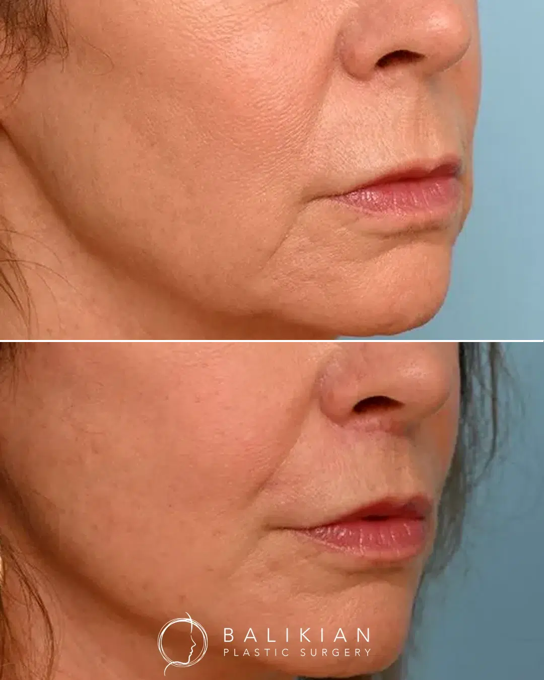 Upper lip lift before and after angled view showing natural contour, proportionate lip size, and rejuvenated appearance.