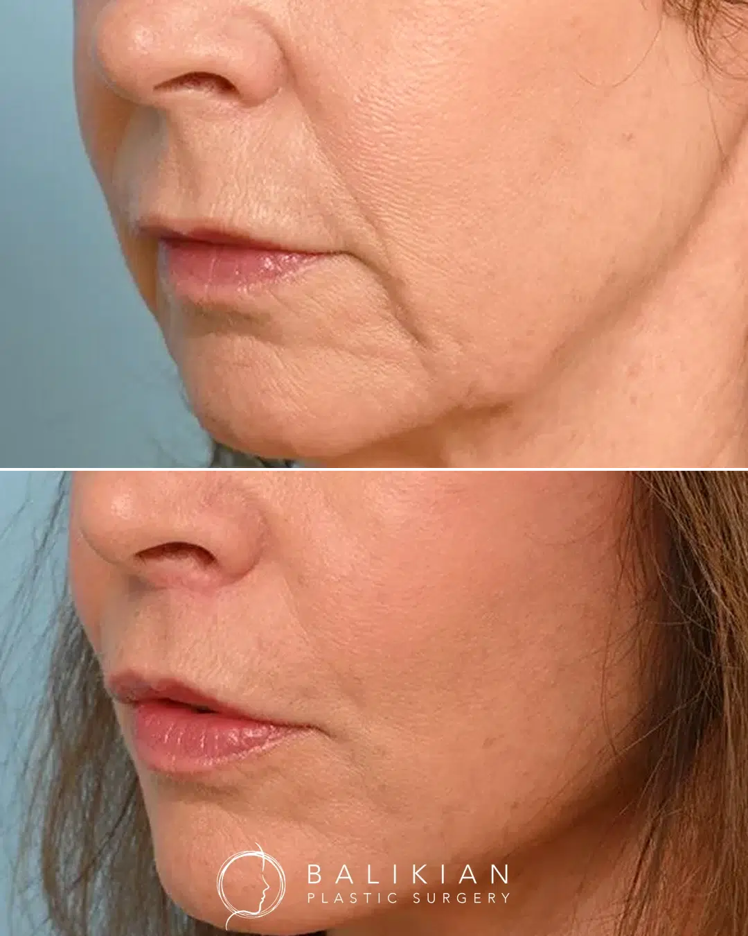 Upper lip lift before and after angled view showing smoother skin, reduced wrinkles around the mouth, and a more defined upper lip contour.