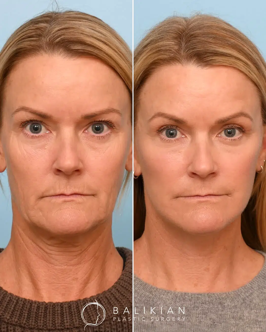 Front view before and after facelift and neck lift showing youthful facial balance and natural contours.