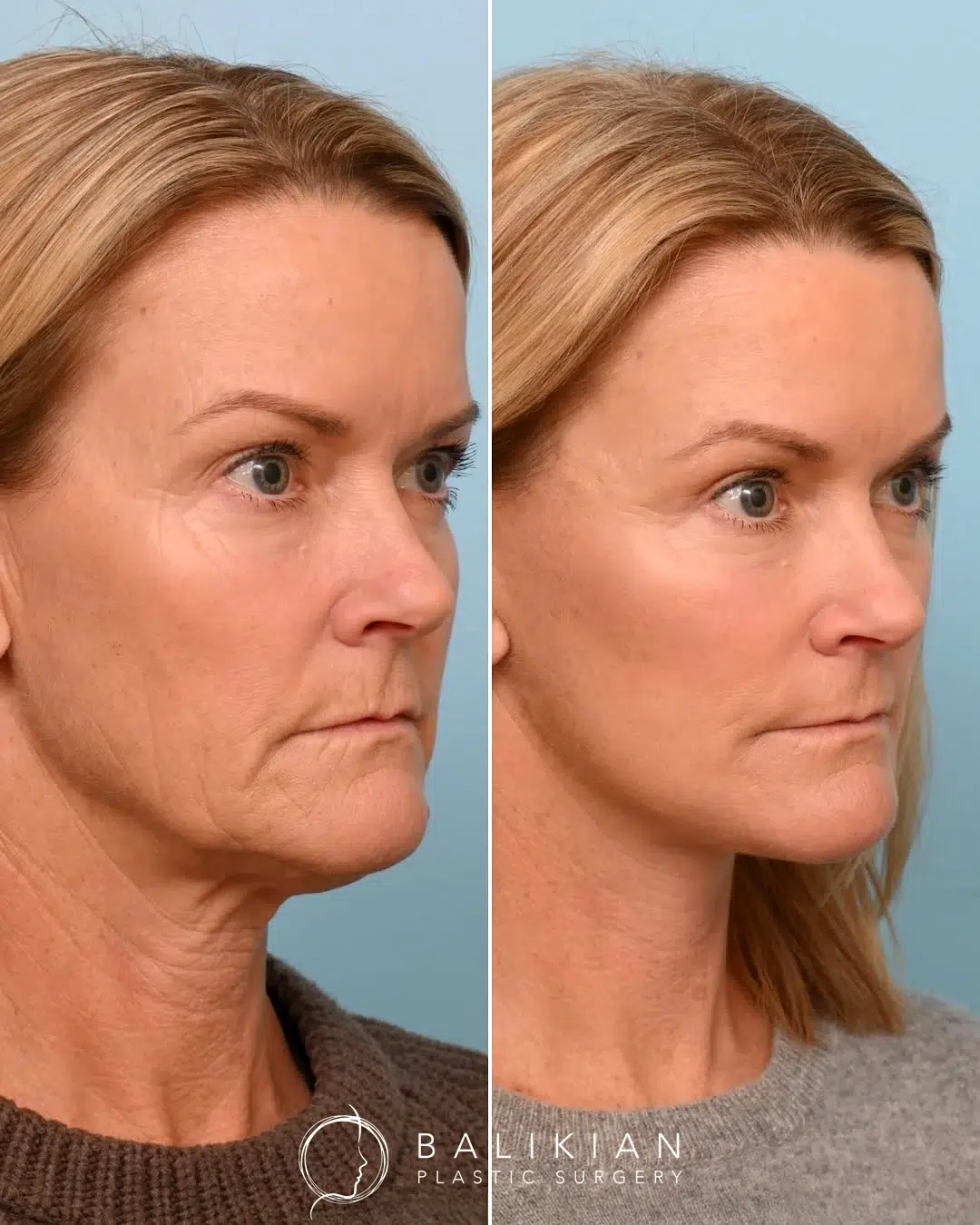 Profile view before and after deep plane facelift and neck lift in Temecula showing smooth neckline and sharper jawline.