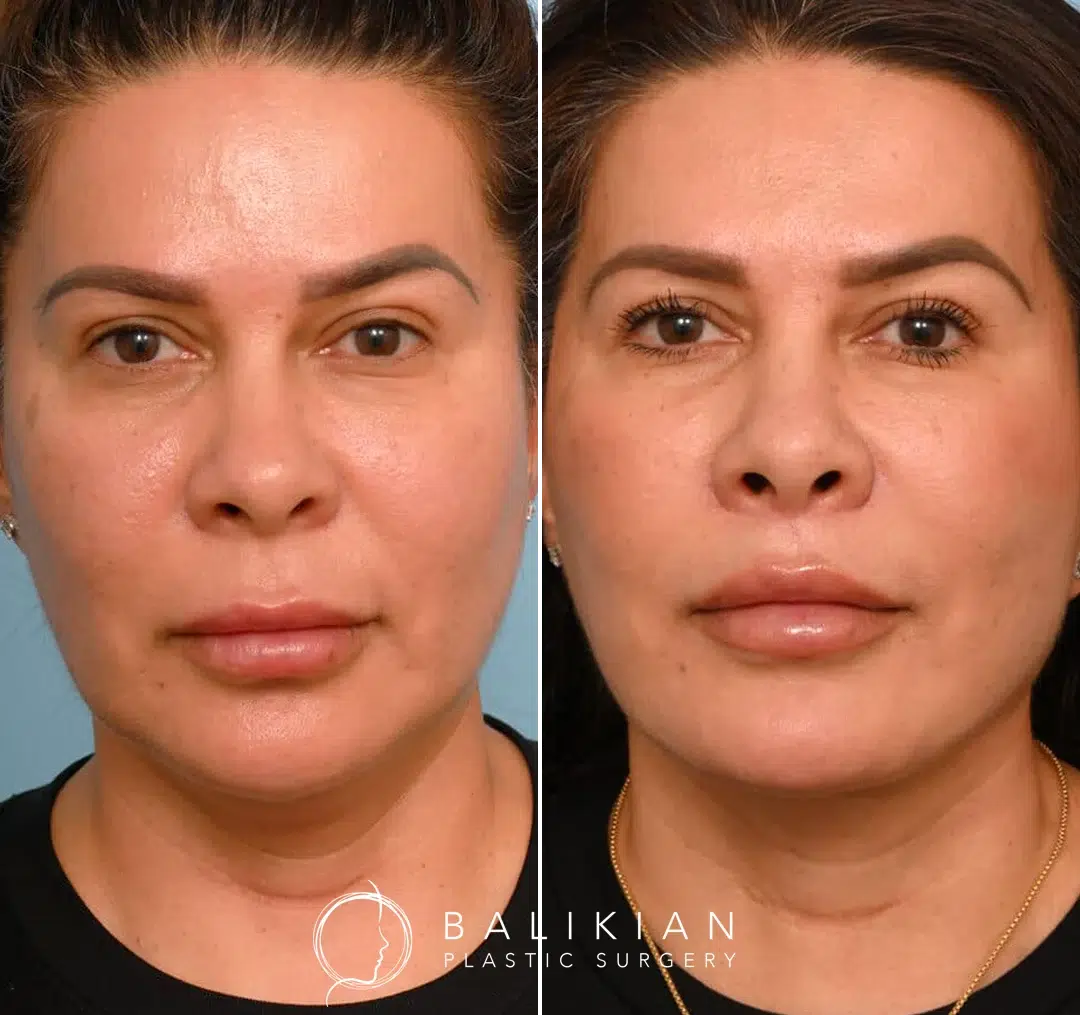Frontal view before and after facelift, showing smoother skin and youthful appearance.