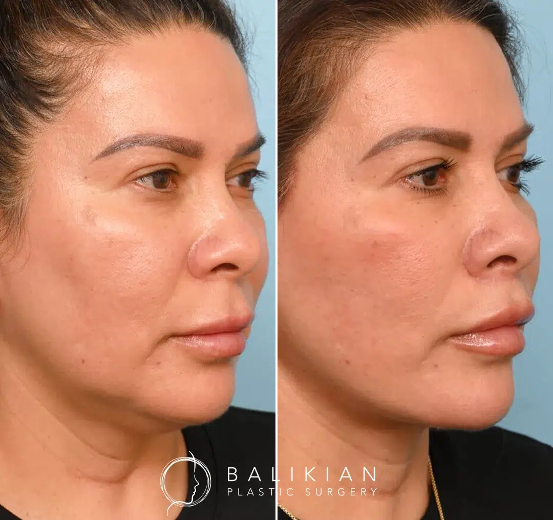 Angled view before and after facelift, showing defined jawline and lifted cheeks.
