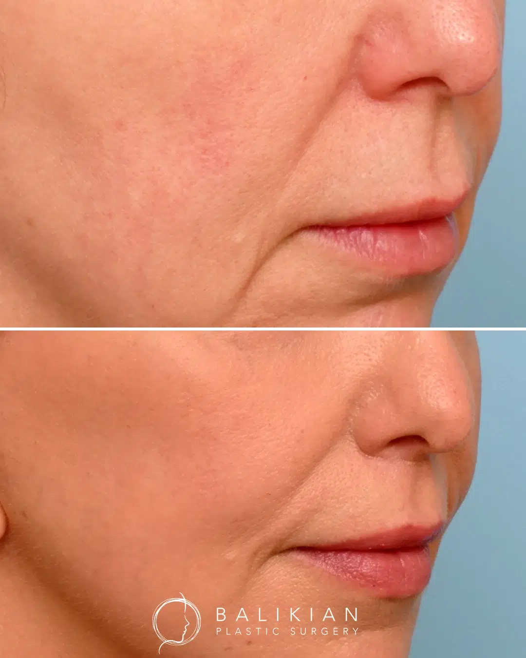 Lip lift before and after angled close-up highlighting enhanced lip shape, shorter philtrum, and balanced facial proportions.