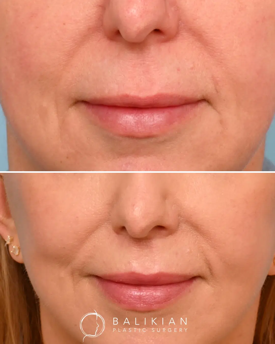 Upper lip lift before and after front view revealing natural fullness, improved cupid’s bow, and a youthful smile.