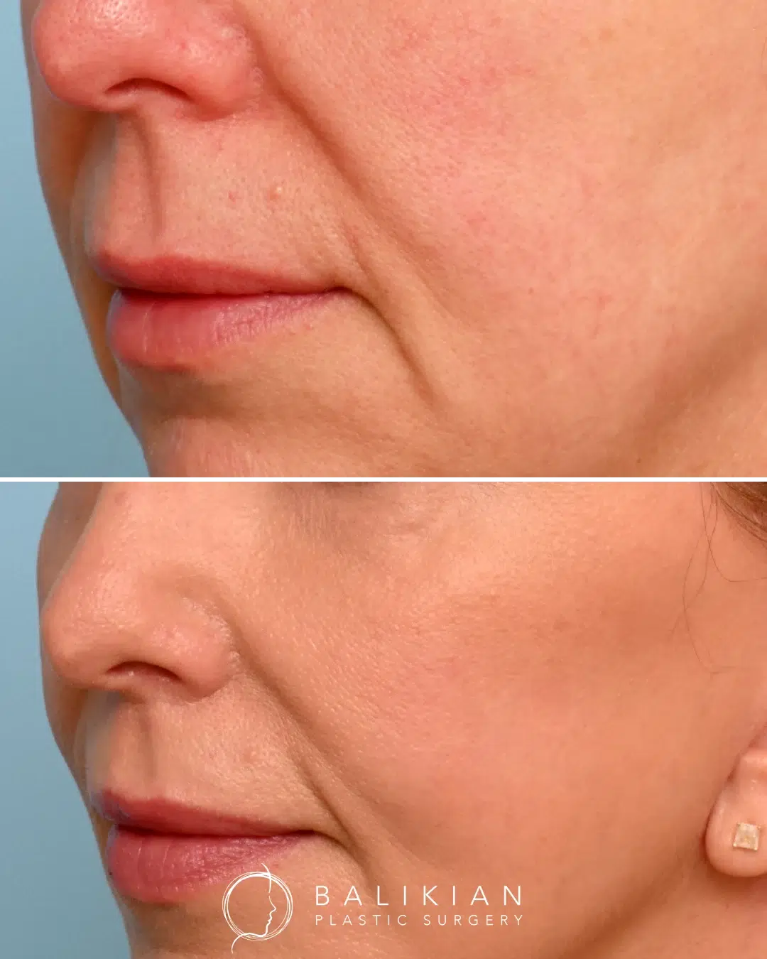 Lip lift before and after angled profile view showing improved lip projection and softened perioral lines.