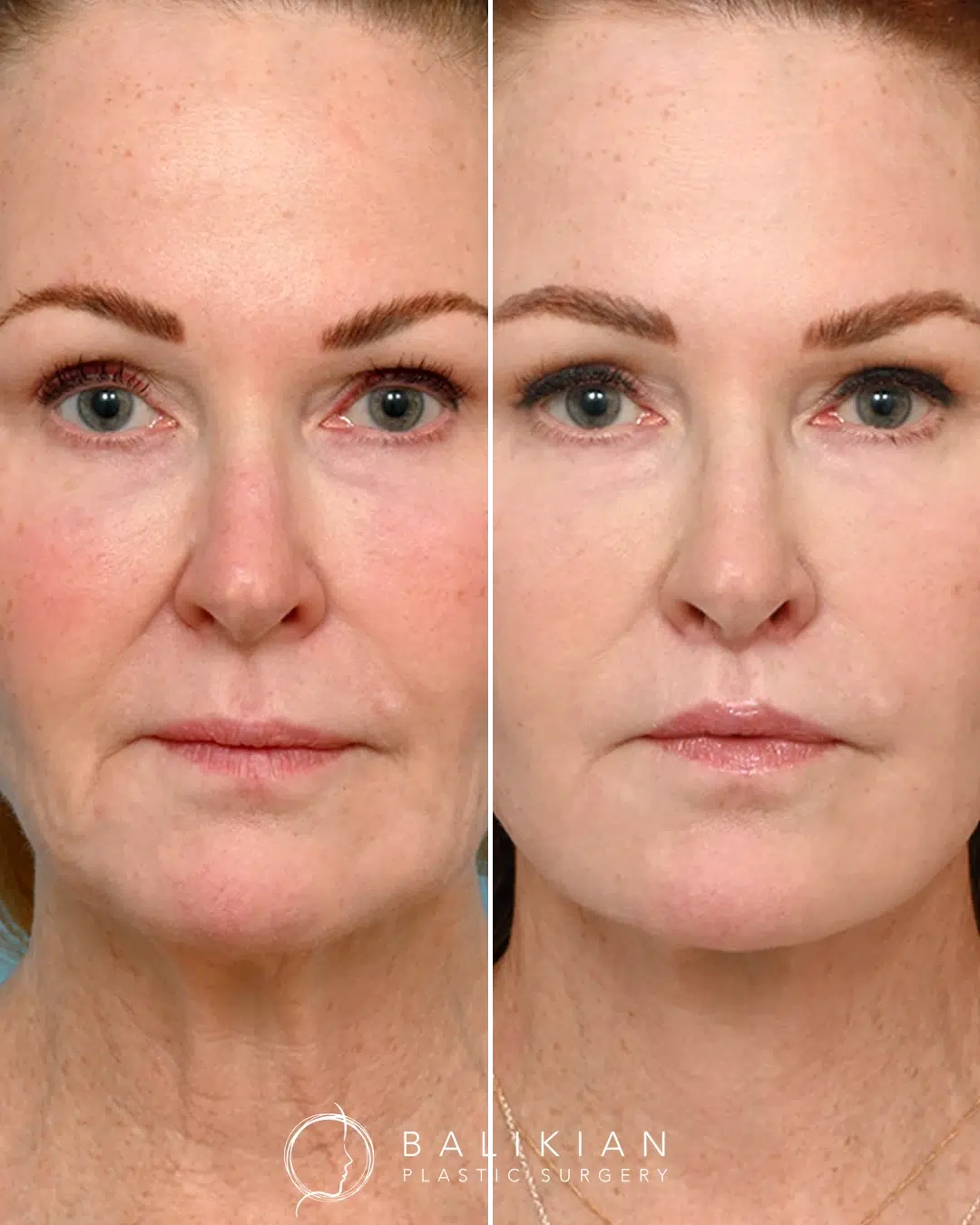 Fractional CO2 laser before and after result in Temecula showing improved skin tone, reduced signs of aging, and natural facial rejuvenation.