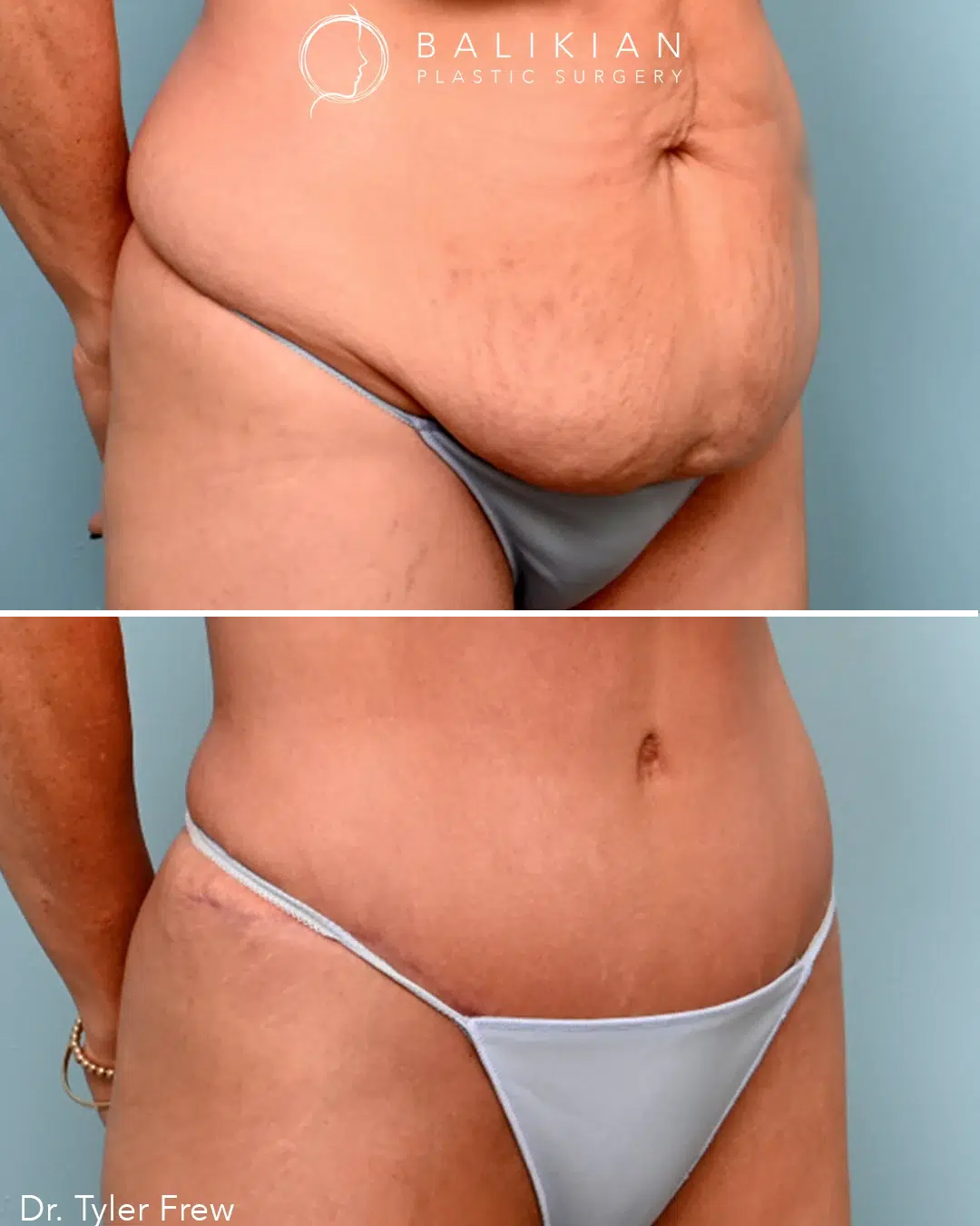 Side view before and after tummy tuck procedure showing elimination of abdominal bulge with a low, discreet scar.