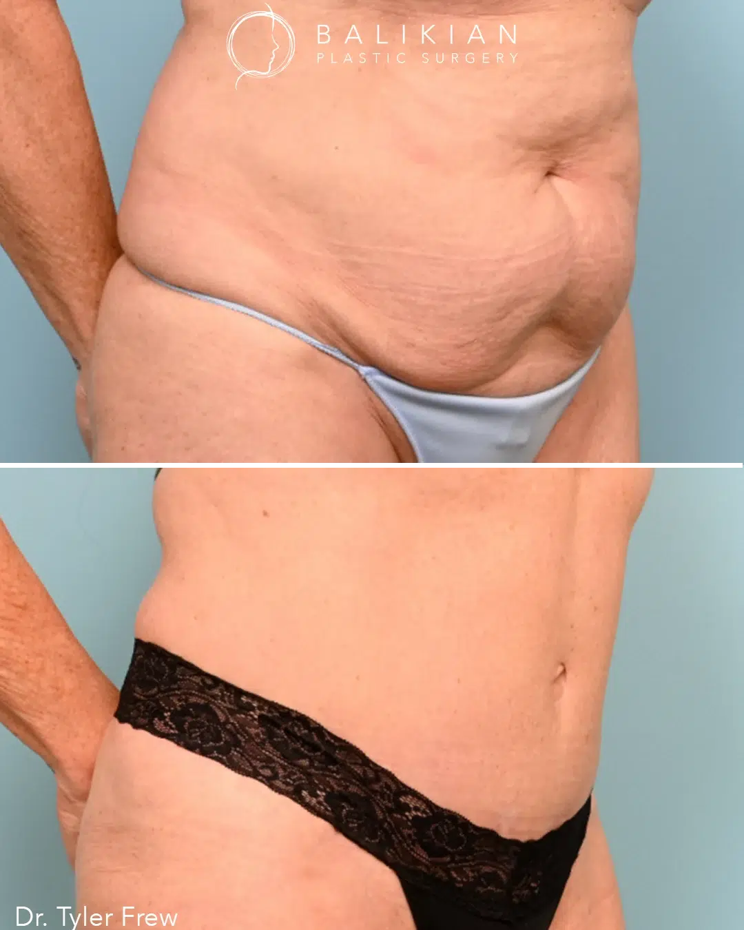 Before and after angled side view of tummy tuck results by Dr. Tyler Frew showing reduced abdominal bulge.