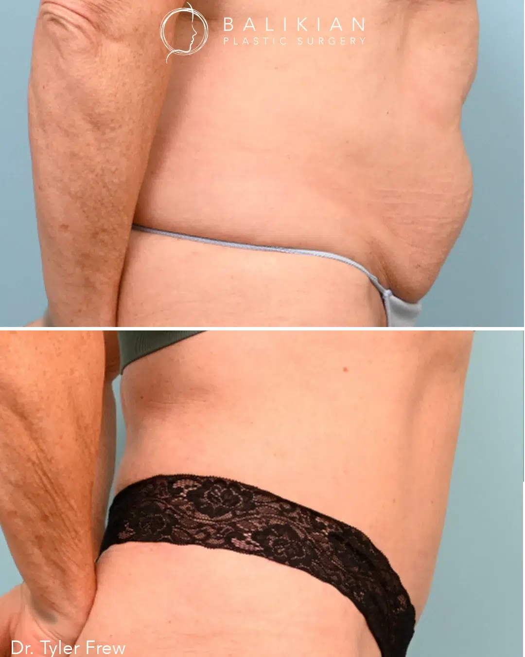 Before and after direct side view of tummy tuck by Dr. Tyler Frew showing skin tightening and smoother waistline.
