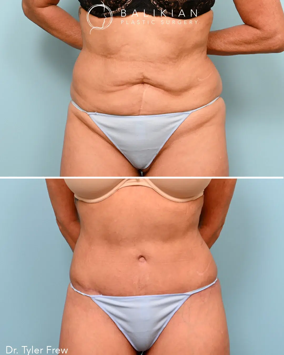 Before and after front view of tummy tuck with liposuction by Dr. Tyler Frew showing a flatter abdomen and refined waistline.